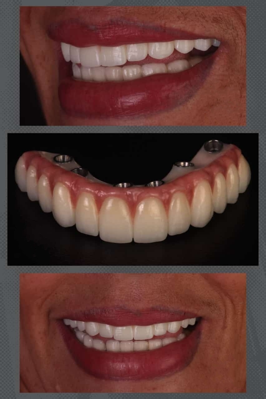 Complete Denture Complete Denture