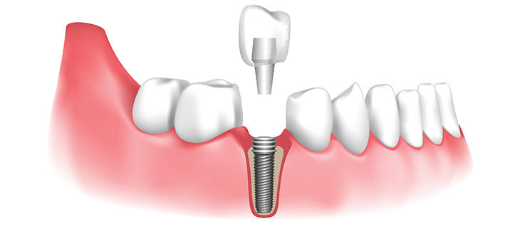 Dental Implant Dental Implant